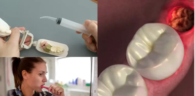 How To Get Food Out Of Wisdom Tooth Hole