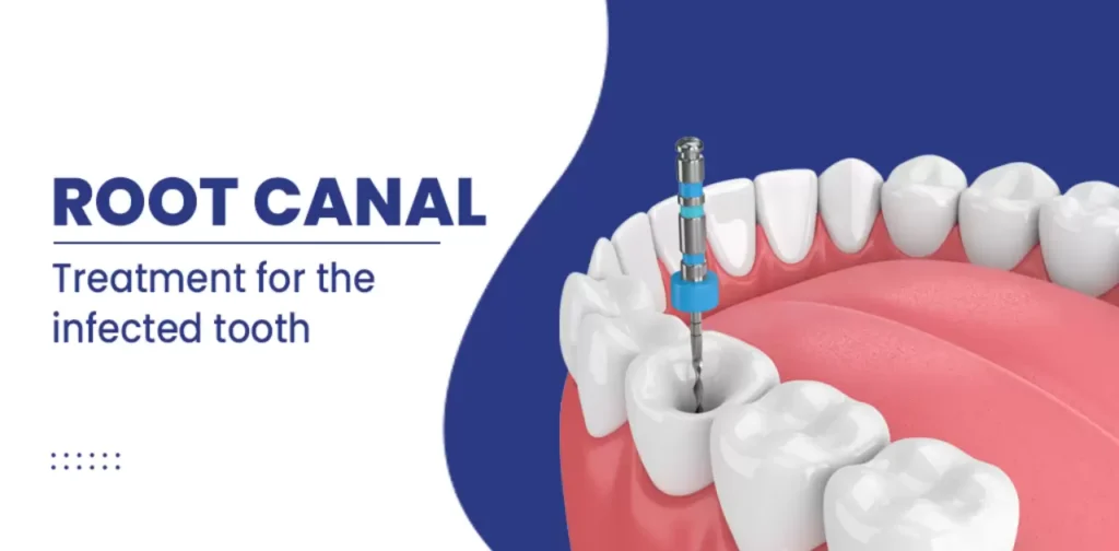 Post-Root Canal Dietary Guidelines