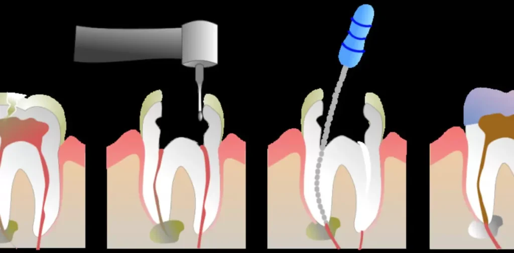 Signs of Complications for A Root Canal